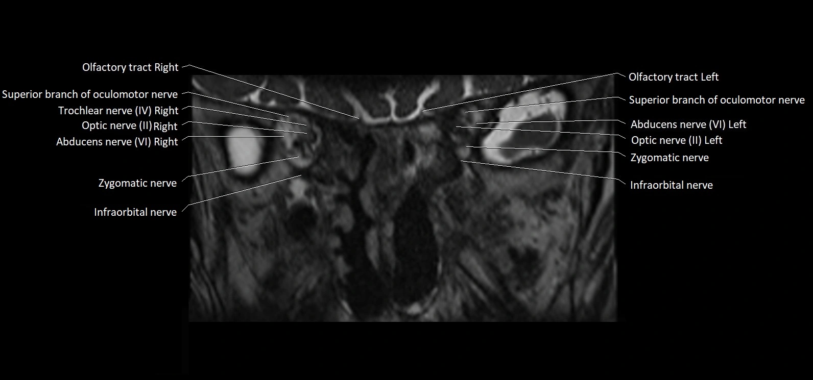 Cranial nerve cross sectional anatomy coronal 3T MRI image 13.webp